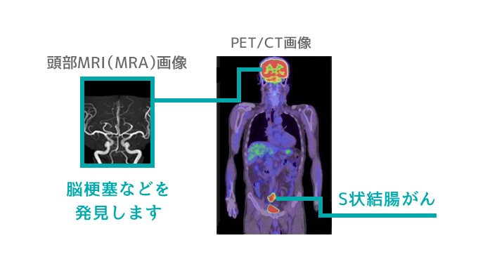 脳梗塞などを発見します